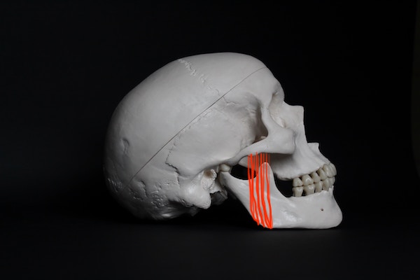 basic illustration of a skull showing roughly where the masseter muscle is located for masseter botox