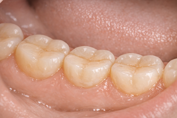 How to Manage Pediatric Bruxism: Effective Approaches for Parents