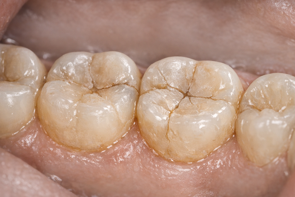 Advanced Clinical Solutions for Bruxism: From Botox to Surgery