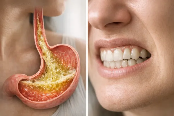 Bruxism and GERD: Understanding the Connection Between Acid Reflux and Teeth Grinding