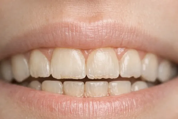 Impact of Long-Term Bruxism on Dental Health: A Dentist’s Perspective
